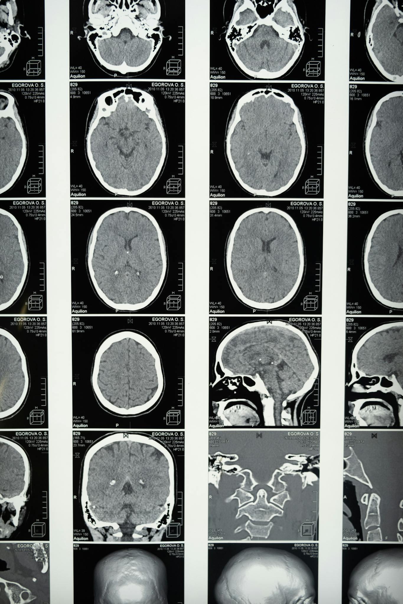 Various brain scans in black and white