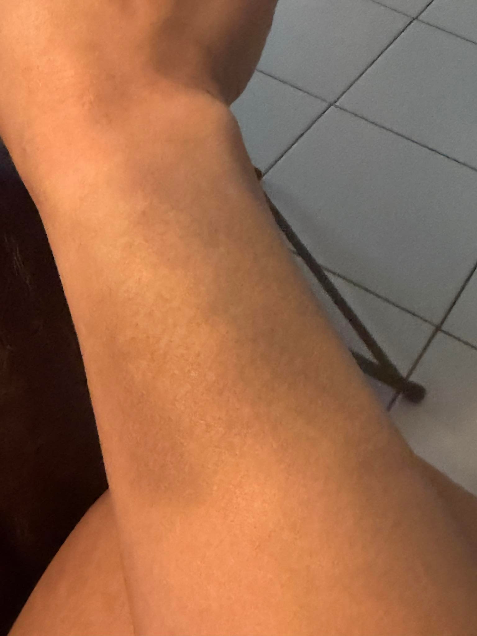 A photo of Lois' bruised arm is seen, as taken 4 days after the incident occured.