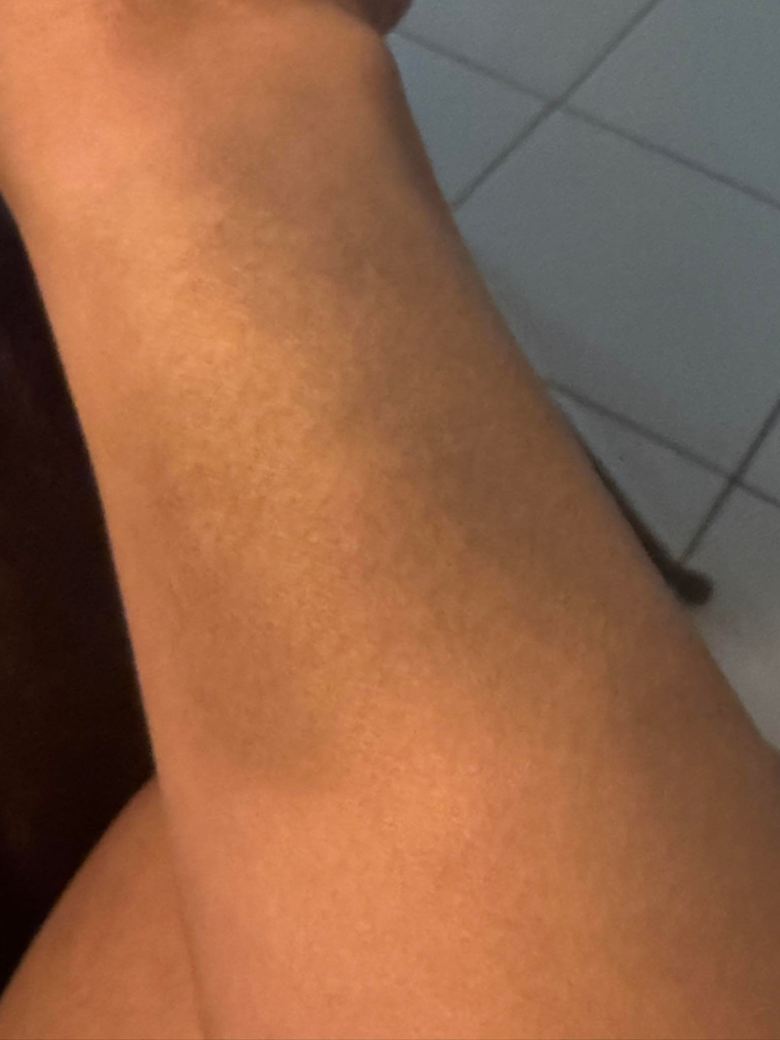 A photo of Lois' bruised arm is seen, as taken 4 days after the incident occured.