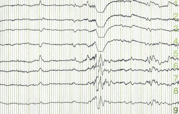 Audiovisual Integration for Infants with Autism and ADHD