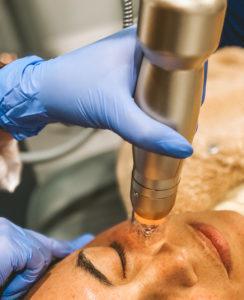 Microneedling Microneedling